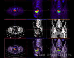 腹部一颗爱心：PET/CT 点亮肠癌诊疗曙光